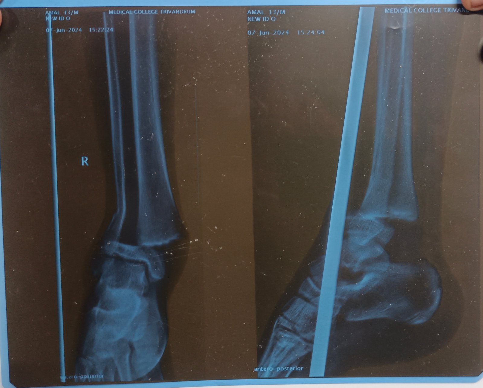 X-ray showing ankle dislocation — complex orthopaedic trauma