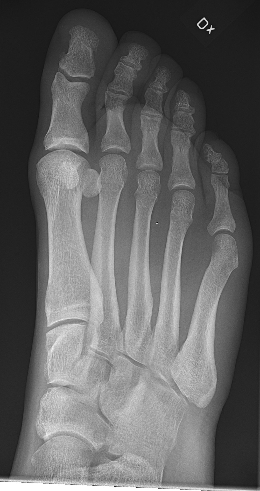 X-ray of foot and ankle