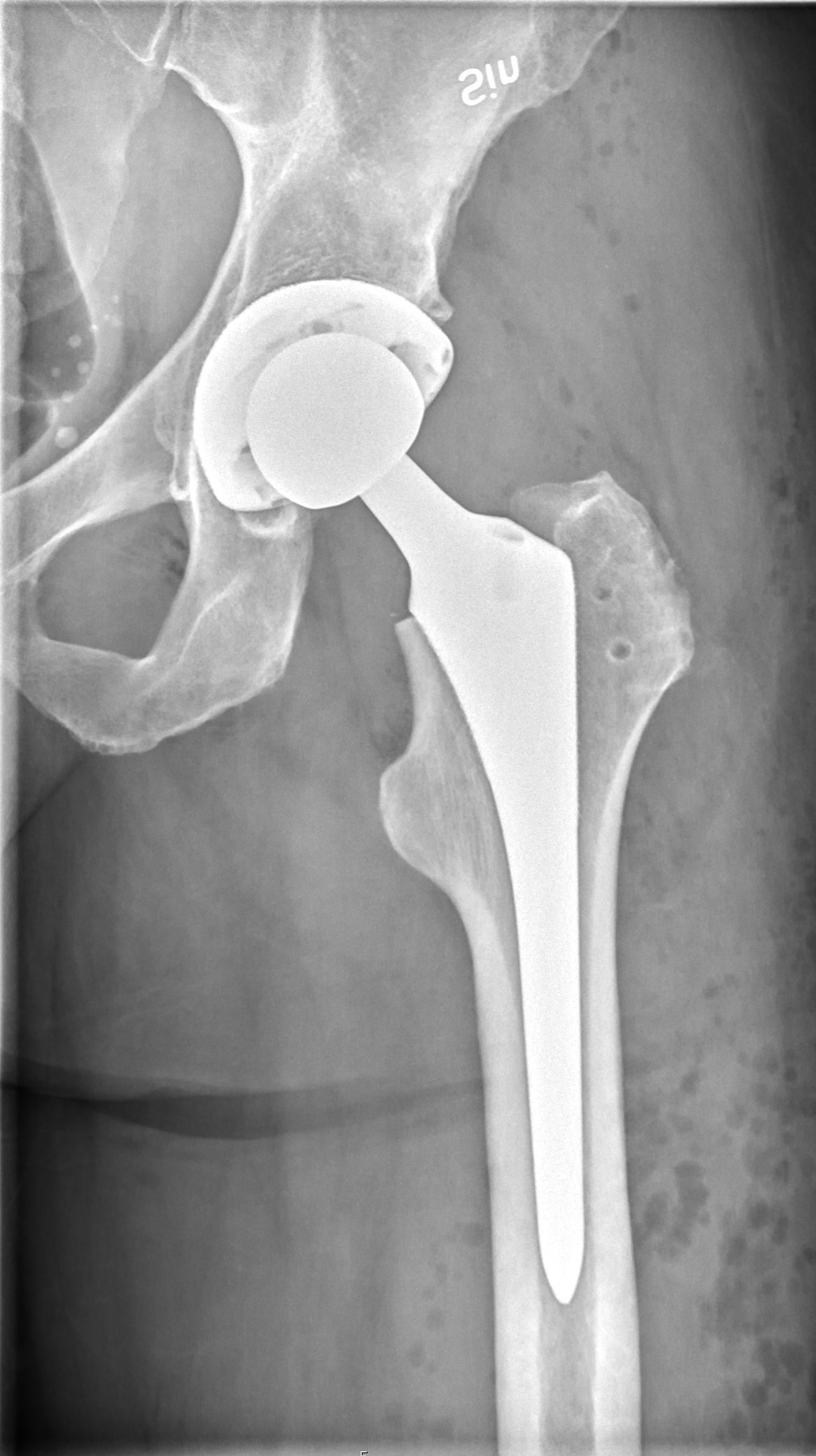 X-ray showing total hip arthroplasty