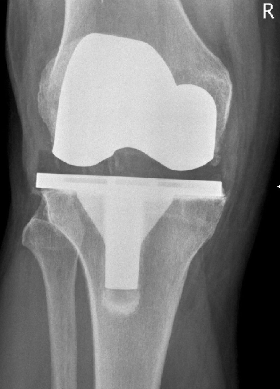 X-ray showing knee prosthesis complication