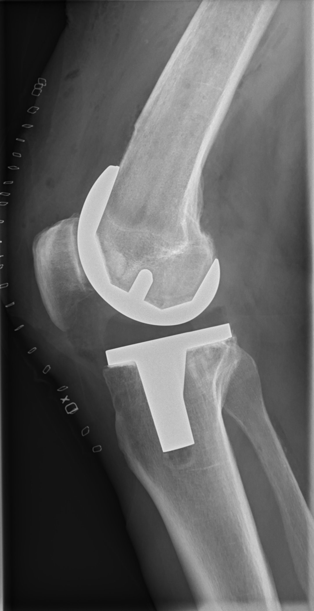 X-ray showing total knee prosthesis