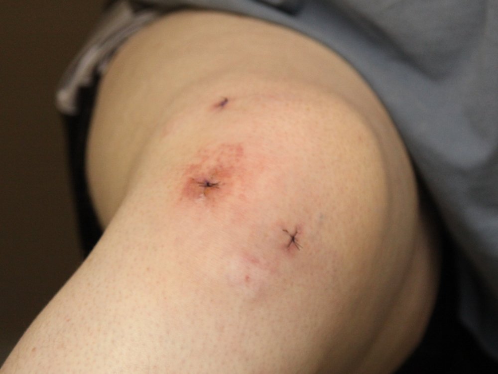 Knee arthroscopic surgery incisions from sports injury