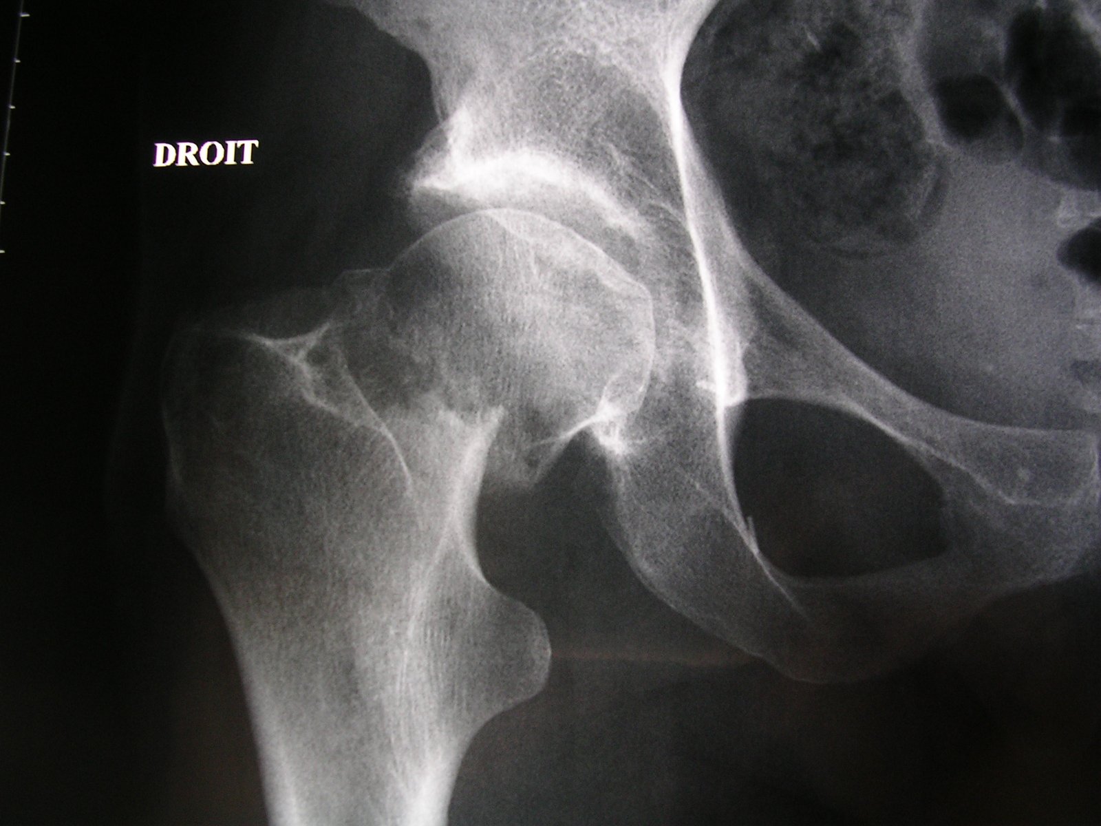 X-ray showing femoral neck fracture